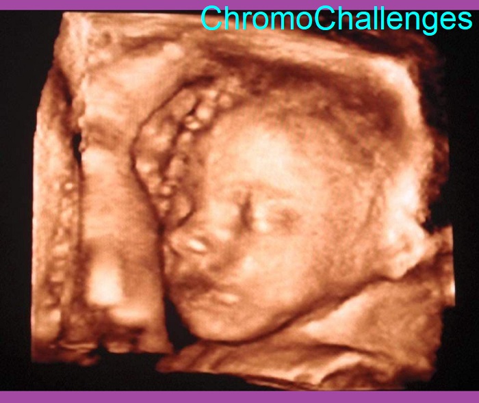 ChromoChallenges Jess Plummer Trisomy Awareness Month 2021 Day 1