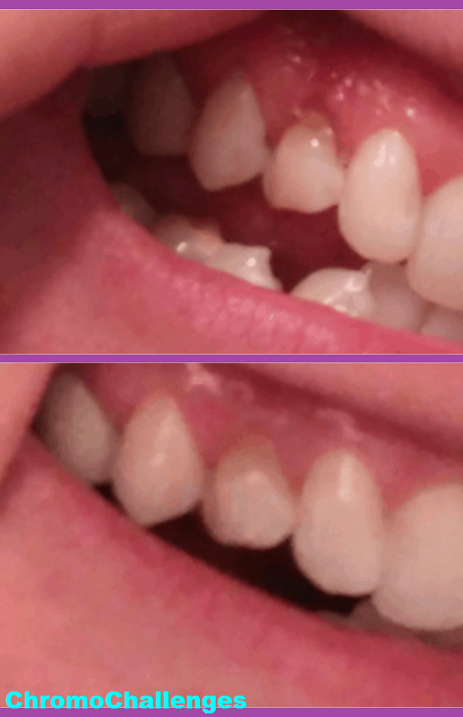 ChromoChallenges Jess Plummer Tooth Remineralization Journey Gum Recession